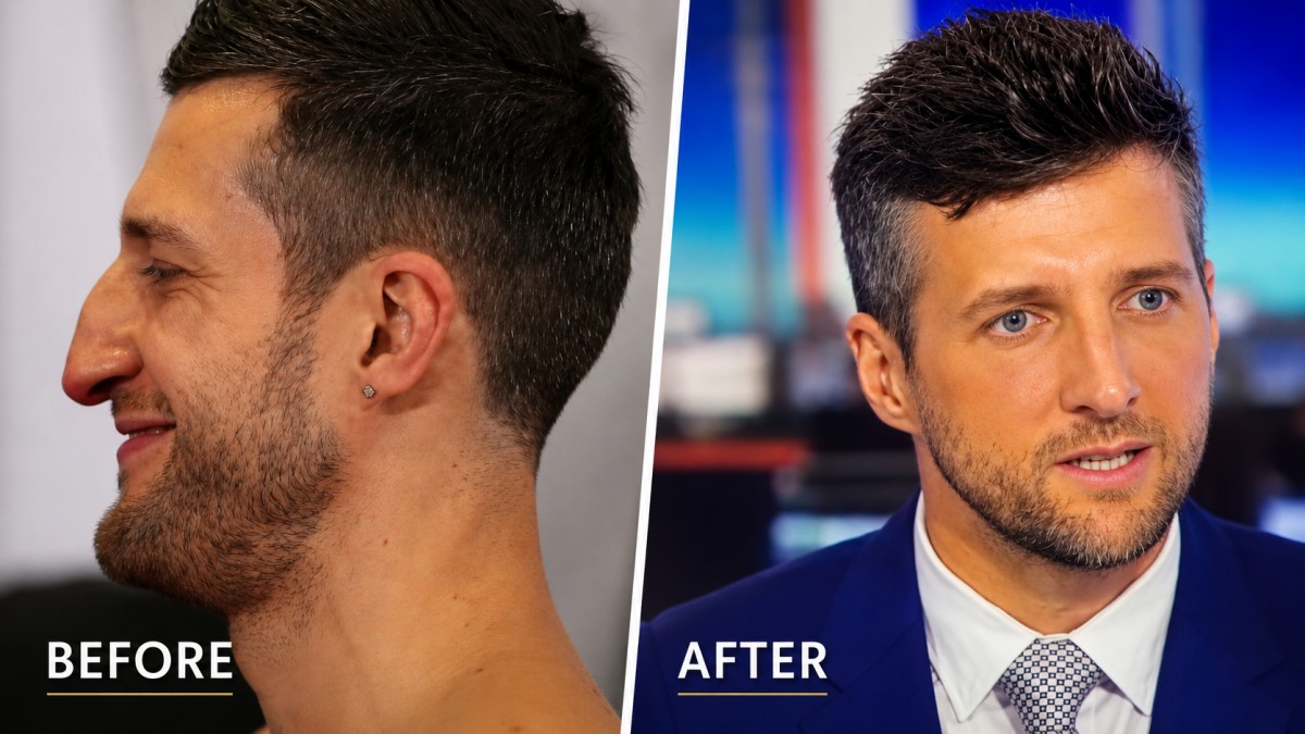 Carl Froch nose job before and after surgery comparison showing the former world champion